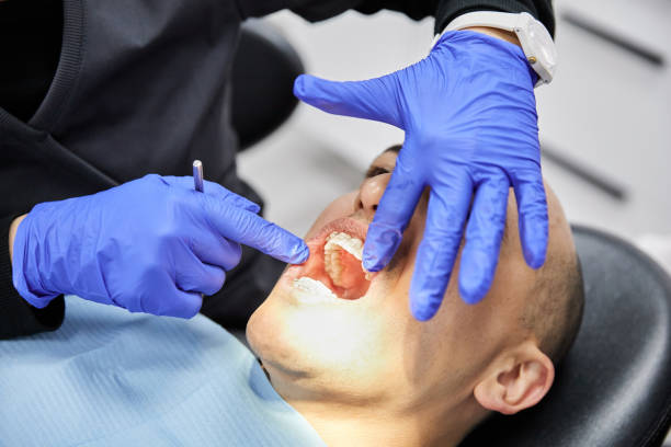 Best Emergency Wisdom Teeth Removal in Sunset, LA
