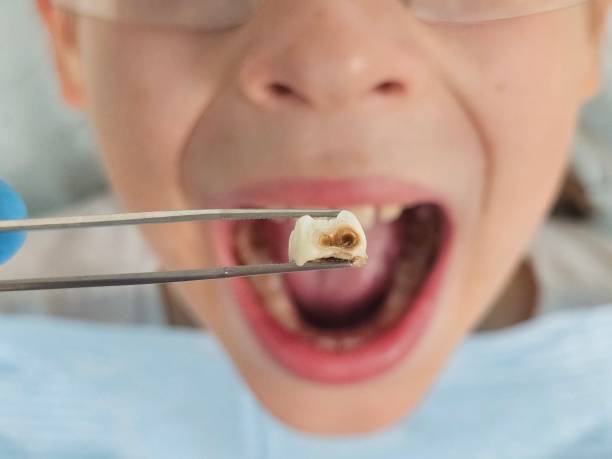 Best Emergency Tooth Extraction in Sunset, LA